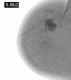 Fibroadenoma (fibroma, adenoma) in the breast – what you should know