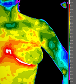 Thermography and detection of breast cancer in women