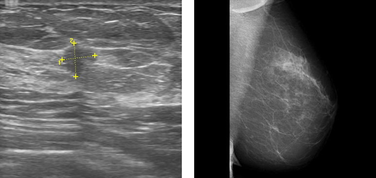 ultrasound and breast mammography