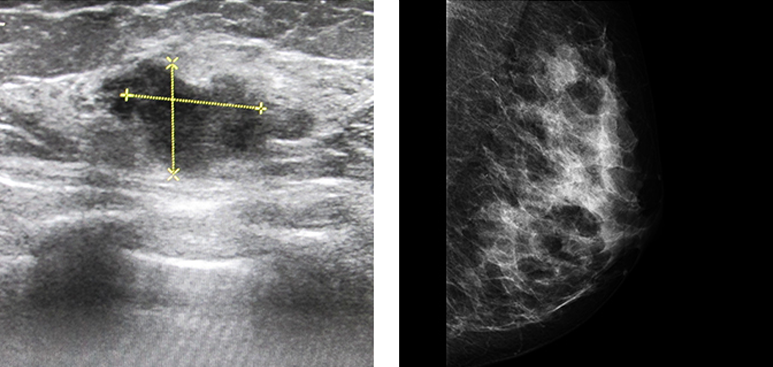 ultrasound and breast mammography