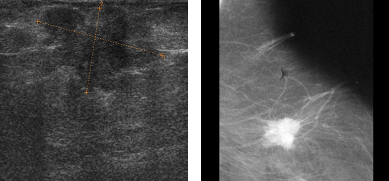 usg i mammografia piersi