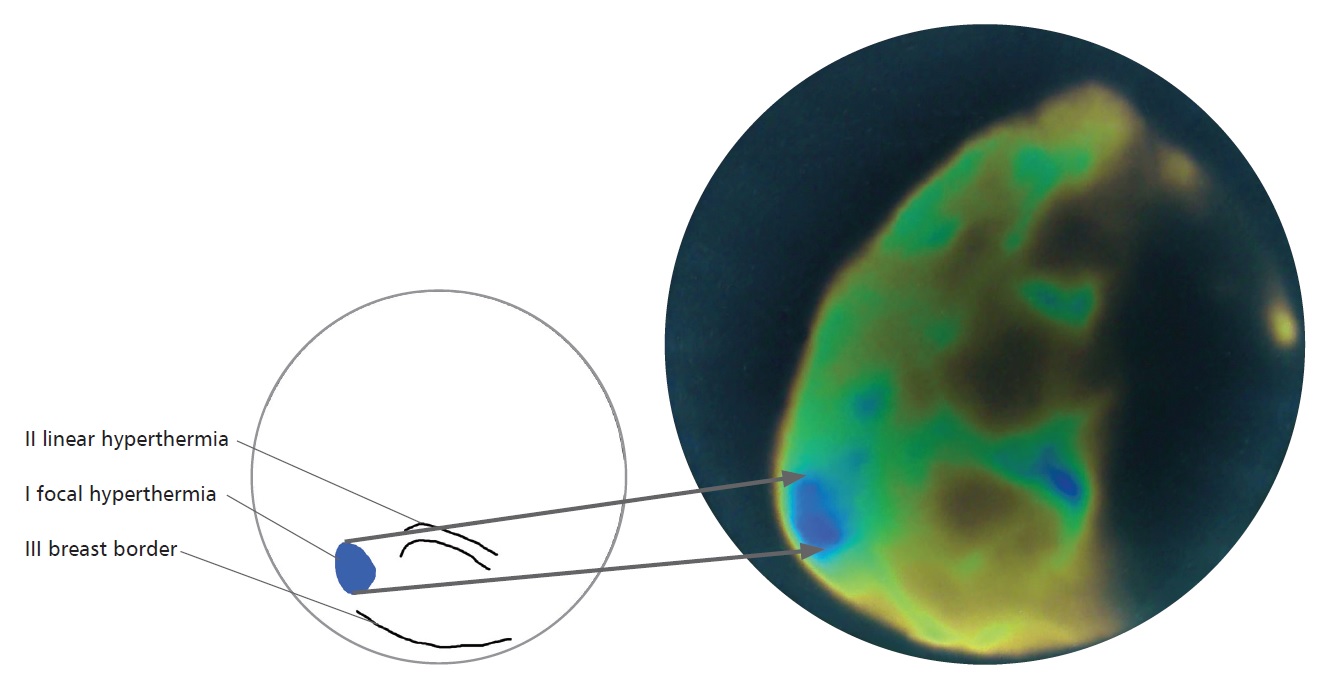 ultrasound and breast mammography