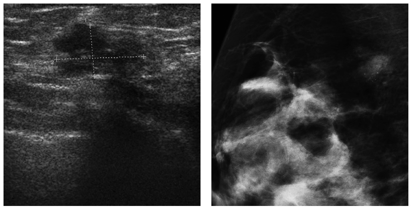 ultrasound and breast mammography