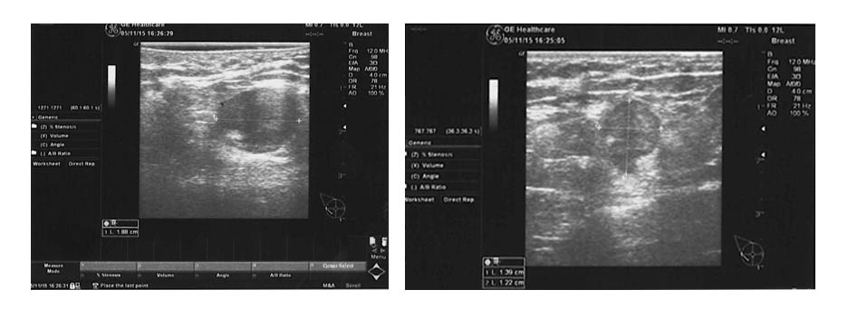 ultrasound breast