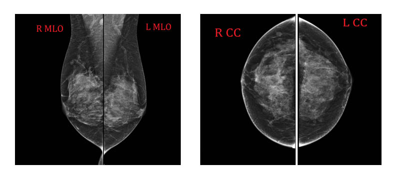 thermographic images of breasts