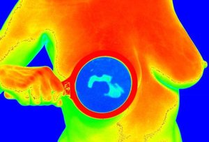 Contact Thermography as an Effective Tool for Detection of Breast Cancer in Women with Dense Breasts-A Case Report